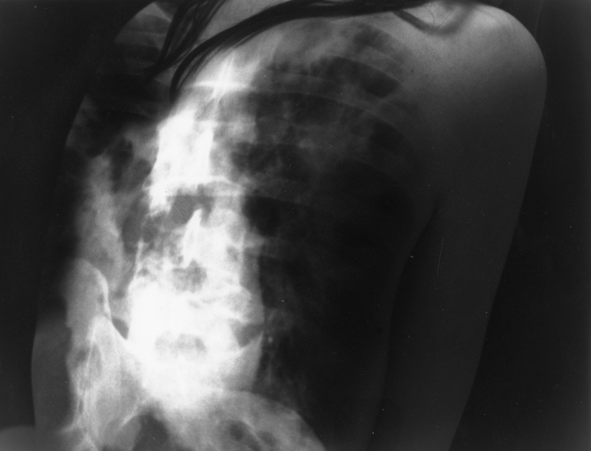 Black and white gelatin silver print of a woman's back with an x-ray of a spine overlaid